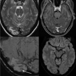Ấu trùng sán dây làm tổ trong não người phụ nữ ở Australia san day anh 1