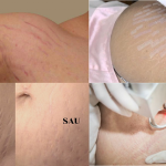 Công nghệ điều trị rạn da bằng laser chỉ có tại THẨM MỸ VIỆN XUÂN TRƯỜNG