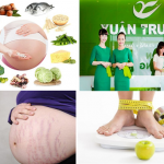 Vượt qua ám ảnh rạn da bụng sau sinh cùng với Thẩm mỹ Xuân Trường