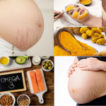 Sự thật về vết rạn da khi mang thai và cách chữa trị hiệu quả tại XUÂN TRƯỜNG